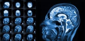 The Long-Term Effects of Traumatic Brain Injuries