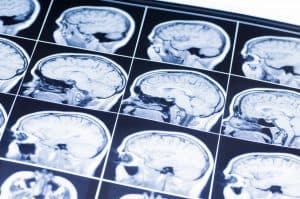 Traumatic Brain Injury and Its Link to Dementia