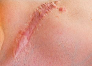 When an Injury Causes Scarring and Disfigurement